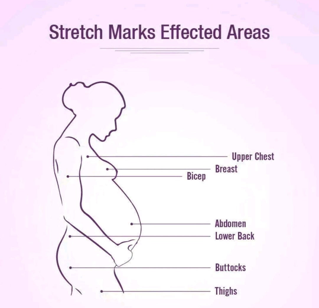 Mederma Stretchmarks Therapy Cream for Skin Repair Fades Stretch Marks Paraben Free Intensive Cream 5.29 oz