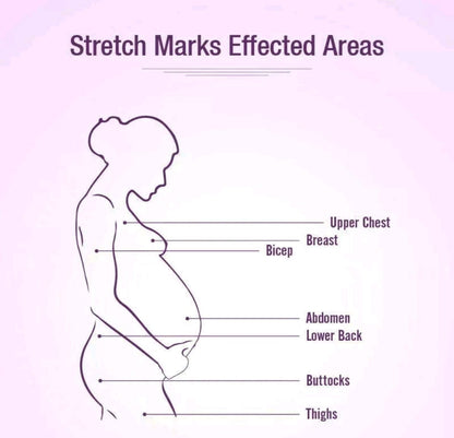 Mederma Stretchmarks Therapy Cream for Skin Repair Fades Stretch Marks Paraben Free Intensive Cream 5.29 oz